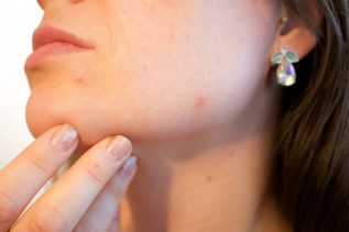 sheffield-acne-facial-treatment